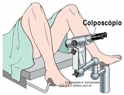 O exame colposcópico